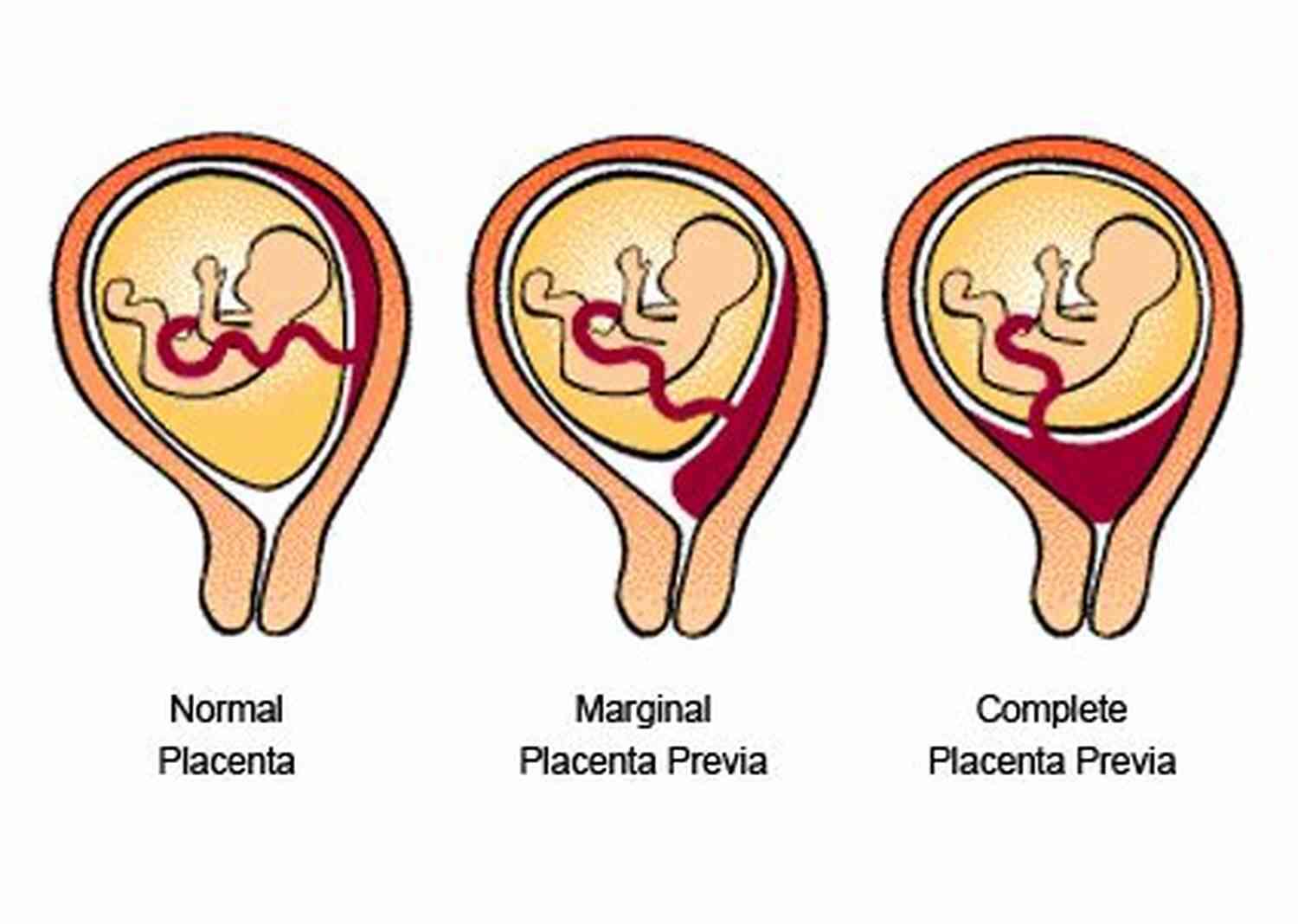 Placenta Praevia Chronicles Of Baby Cait A Touching Journey Of Survival And Love Placenta Praevia: Chronicles Of Baby Cait
